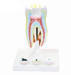 Модель Строение зуба человека с кариесом