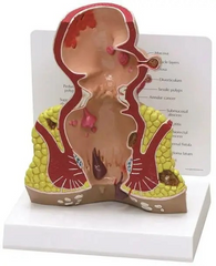 Anatomical model of the rectum with pathologies in the context of MENTAL
